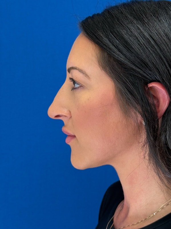 Rhinoplasty Before & After Image
