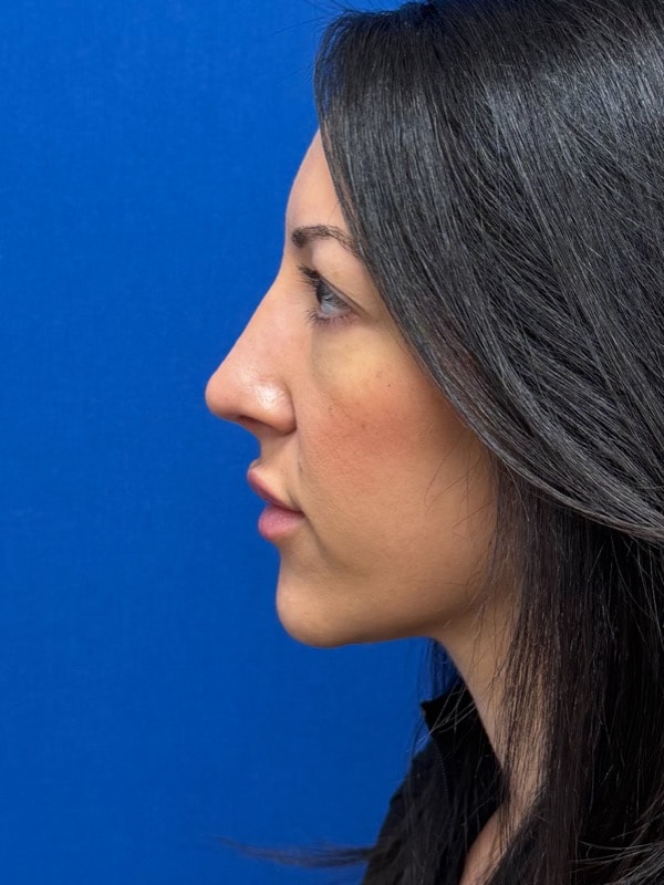Rhinoplasty Before & After Image