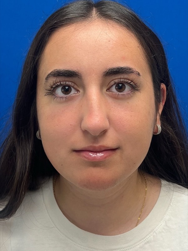 Rhinoplasty Before & After Image