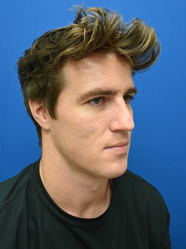 Rhinoplasty Before & After Image