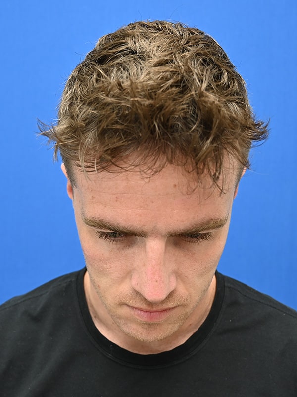 Rhinoplasty Before & After Image