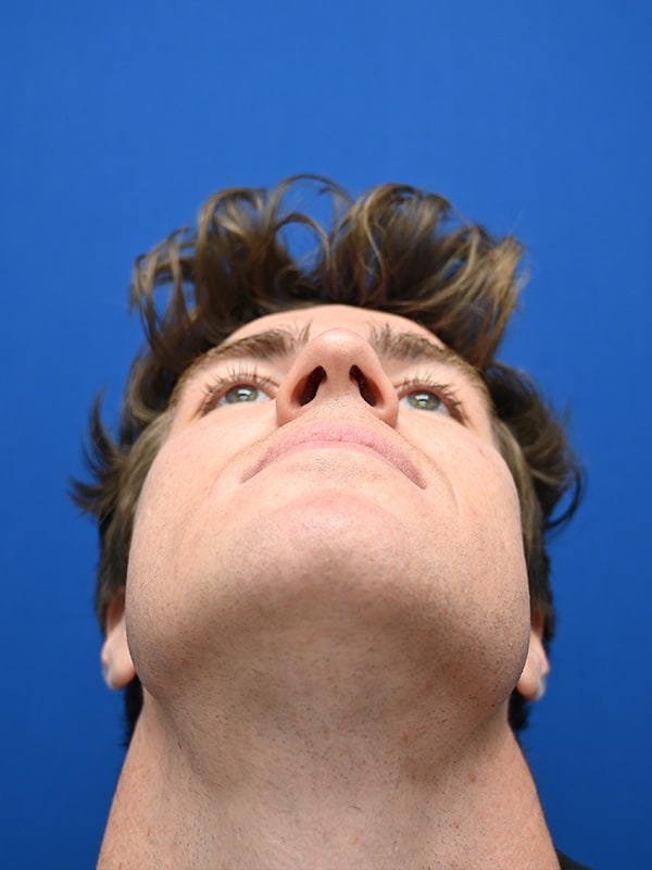 Rhinoplasty Before & After Image