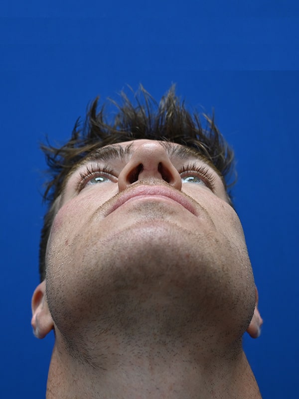 Rhinoplasty Before & After Image