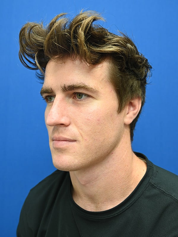 Rhinoplasty Before & After Image