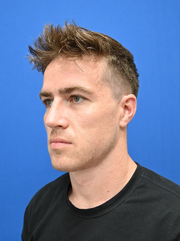 Rhinoplasty Before & After Image