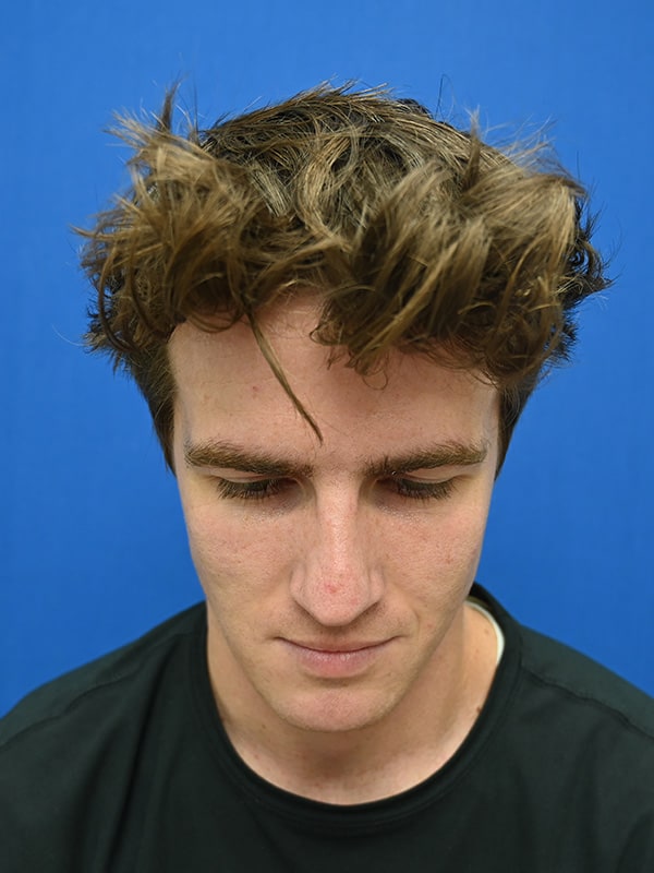 Rhinoplasty Before & After Image