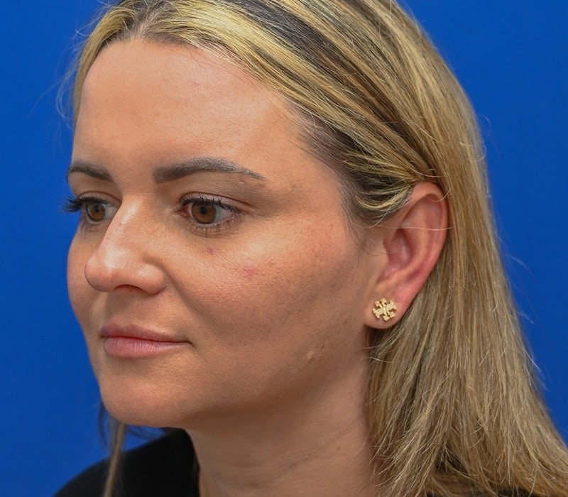 Rhinoplasty Before & After Image