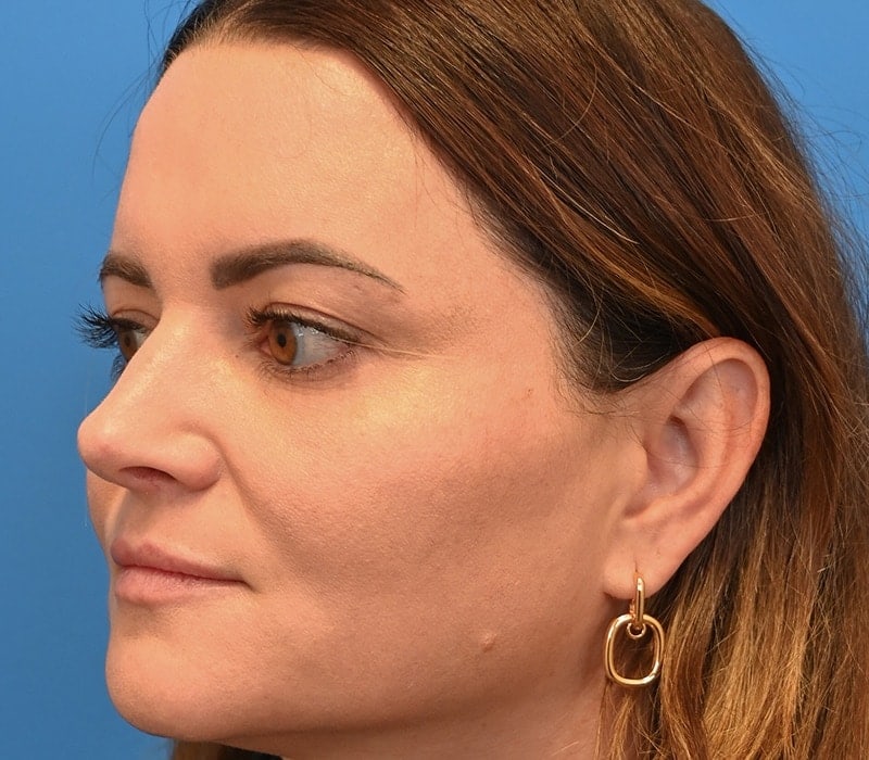 Rhinoplasty Before & After Image