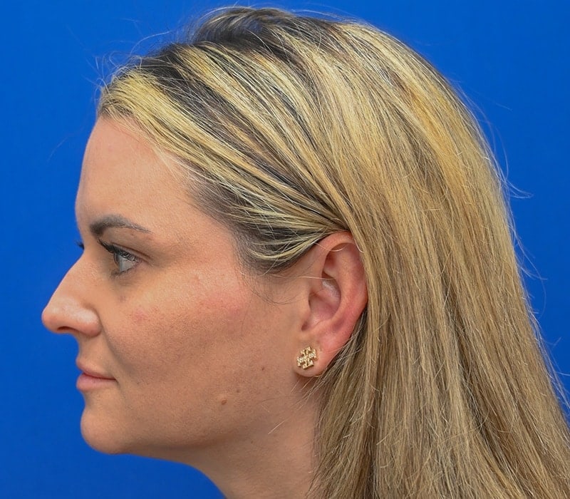 Rhinoplasty Before & After Image