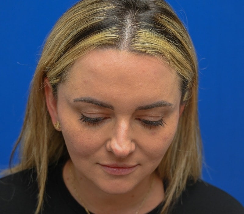 Rhinoplasty Before & After Image