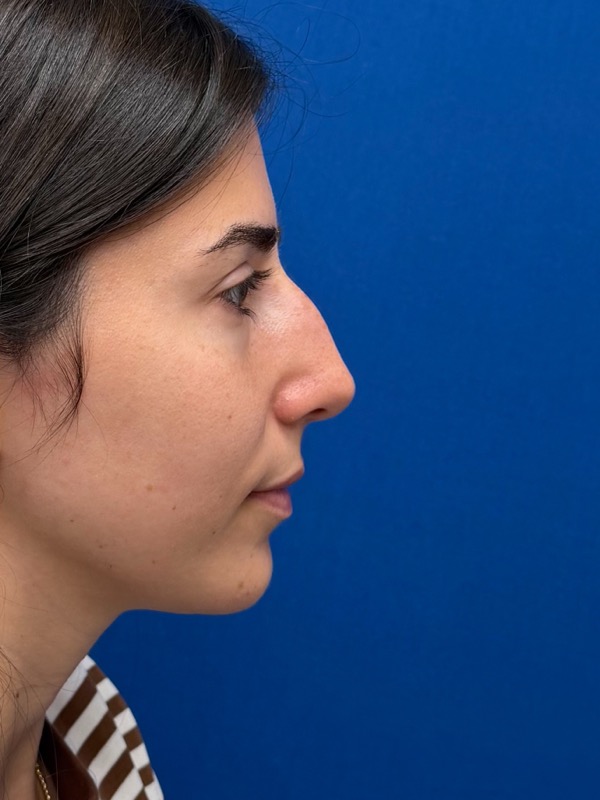 Rhinoplasty Before & After Image