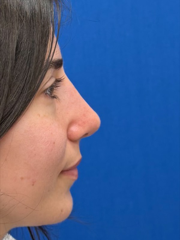 Rhinoplasty Before & After Image