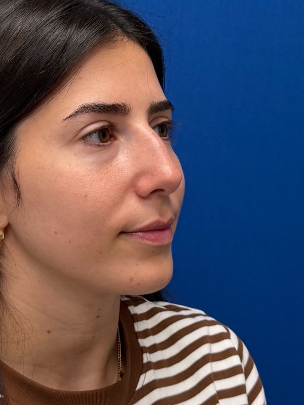 Rhinoplasty Before & After Image