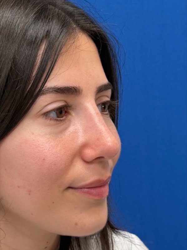 Rhinoplasty Before & After Image