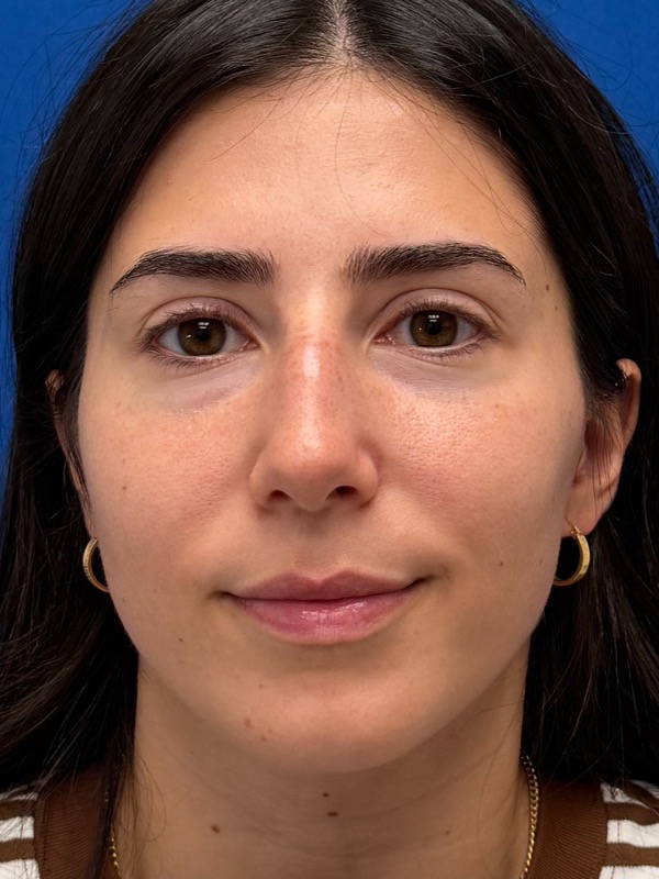Rhinoplasty Before & After Image