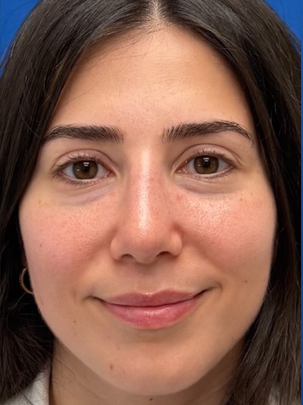 Rhinoplasty Before & After Image