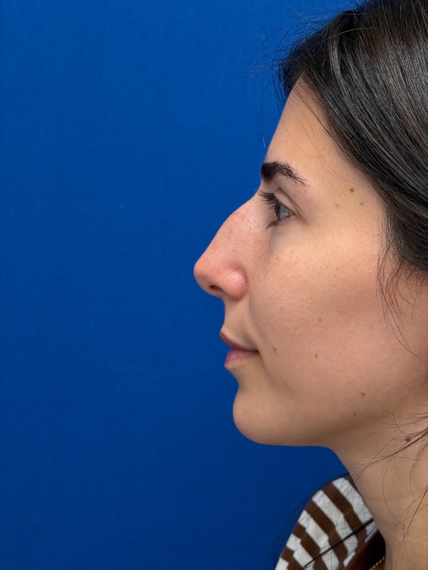 Rhinoplasty Before & After Image
