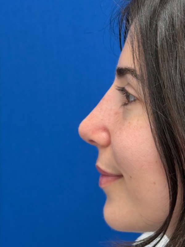 Rhinoplasty Before & After Image