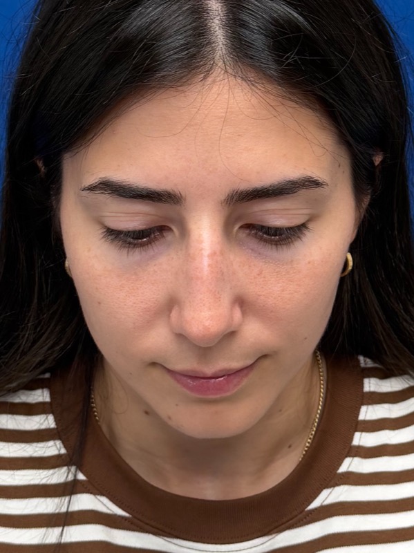 Rhinoplasty Before & After Image