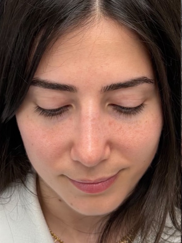 Rhinoplasty Before & After Image