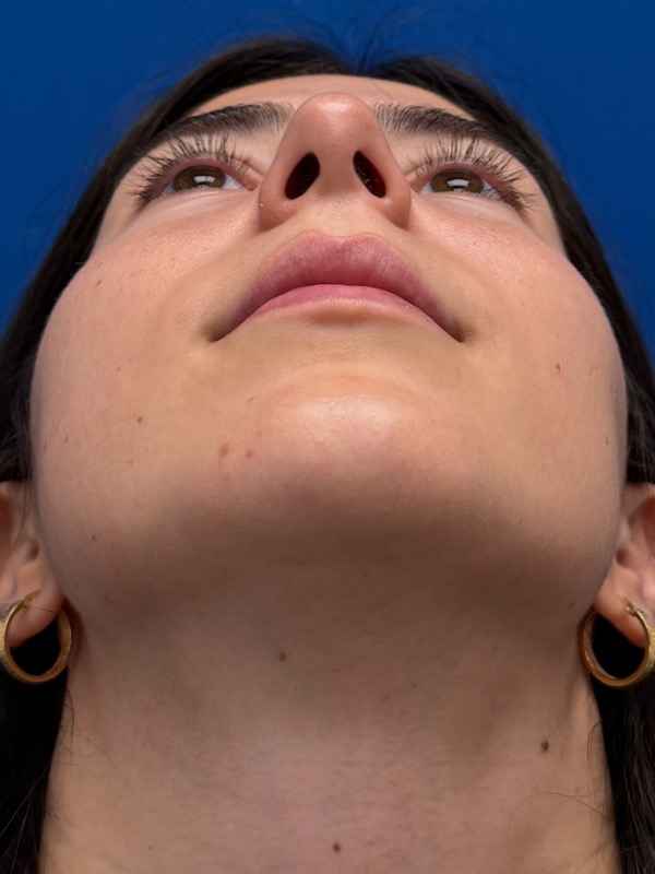Rhinoplasty Before & After Image