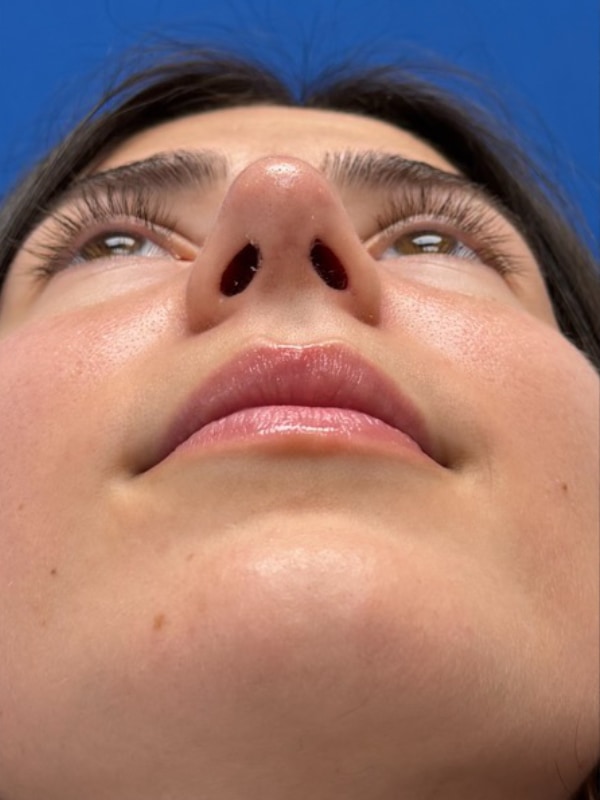 Rhinoplasty Before & After Image