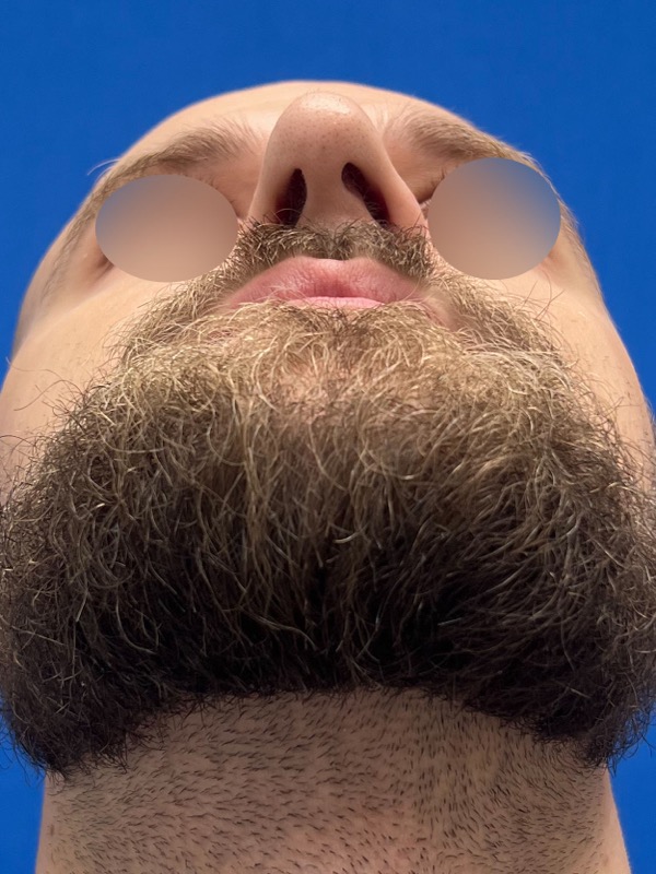 Rhinoplasty Before & After Image