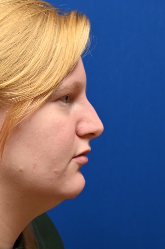 Rhinoplasty Before & After Image
