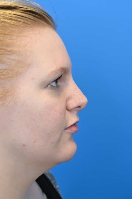 Rhinoplasty Before & After Image
