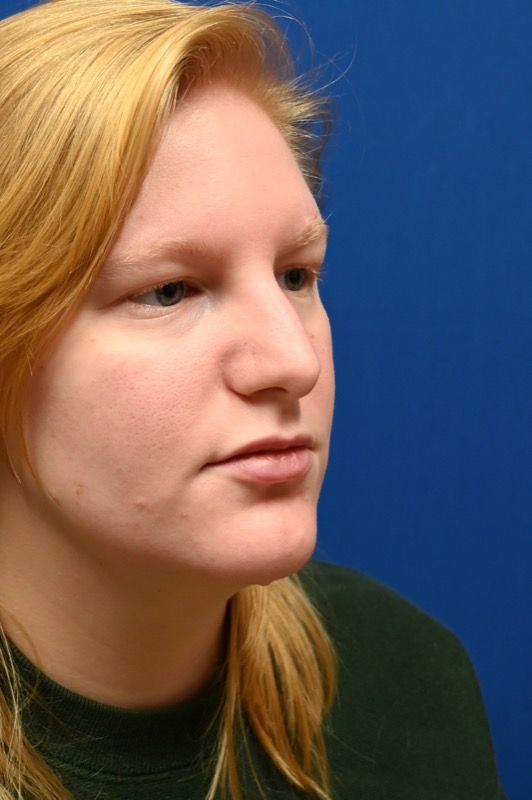 Rhinoplasty Before & After Image