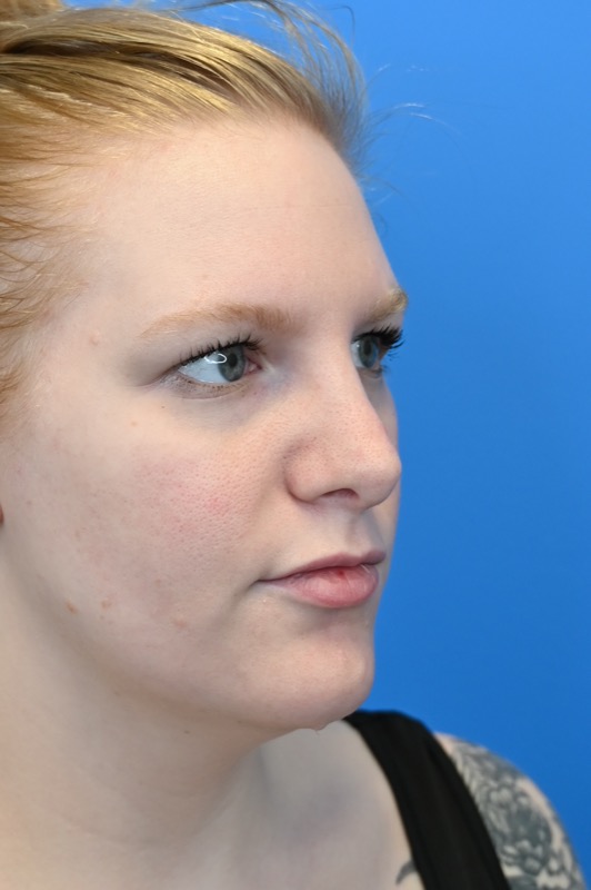 Rhinoplasty Before & After Image