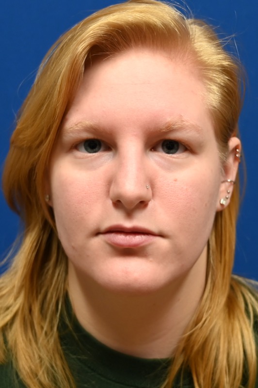 Rhinoplasty Before & After Image