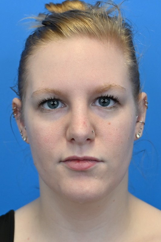 Rhinoplasty Before & After Image