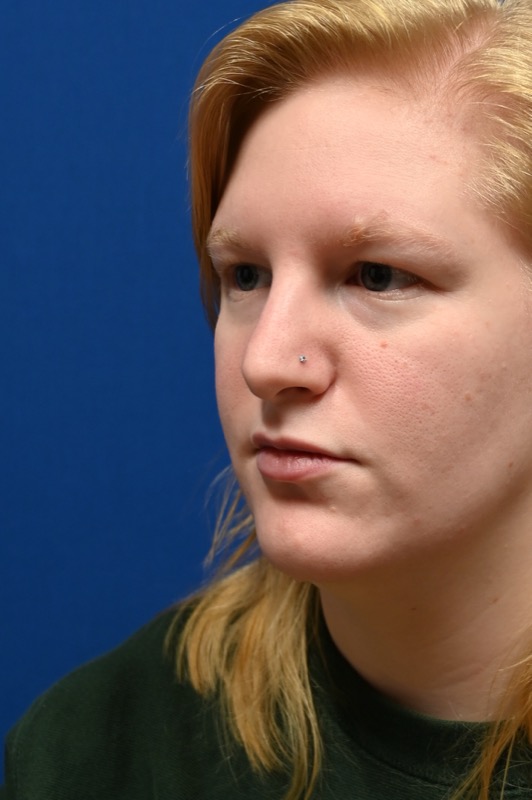 Rhinoplasty Before & After Image
