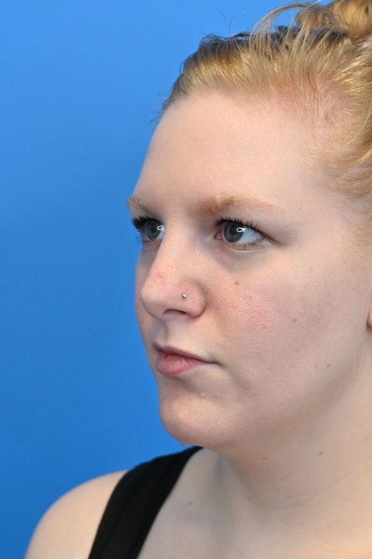 Rhinoplasty Before & After Image
