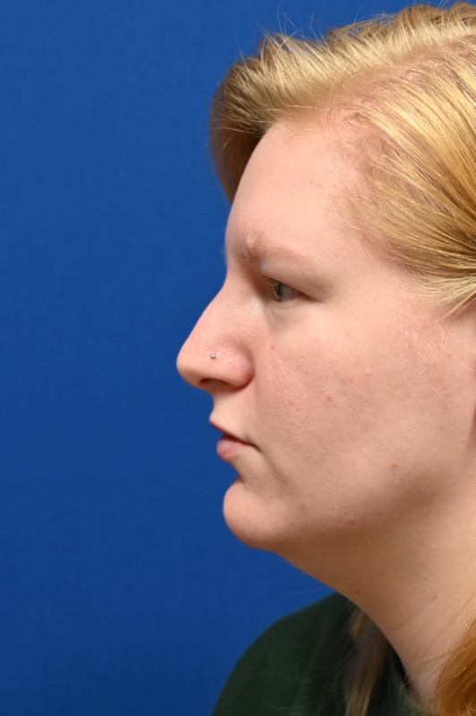 Rhinoplasty Before & After Image