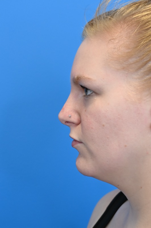 Rhinoplasty Before & After Image