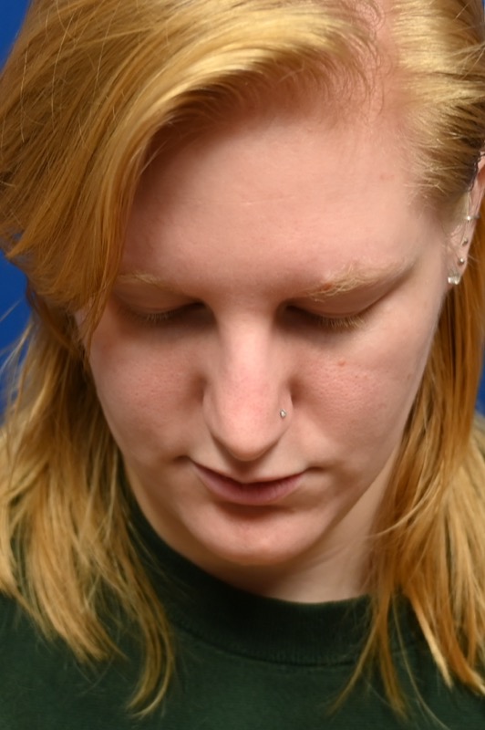Rhinoplasty Before & After Image
