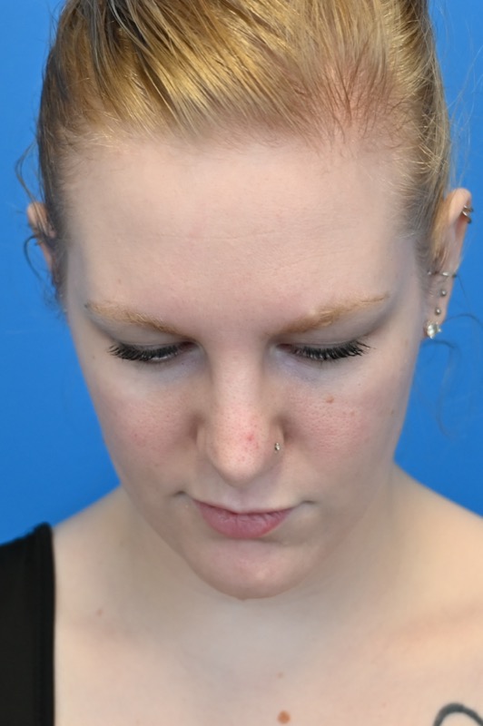 Rhinoplasty Before & After Image