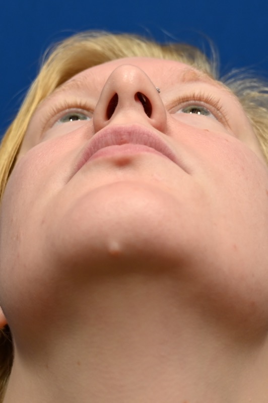 Rhinoplasty Before & After Image