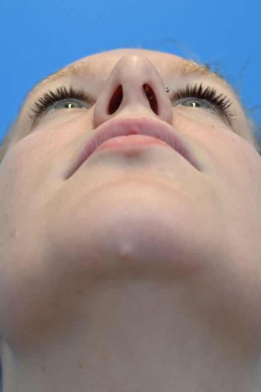 Rhinoplasty Before & After Image