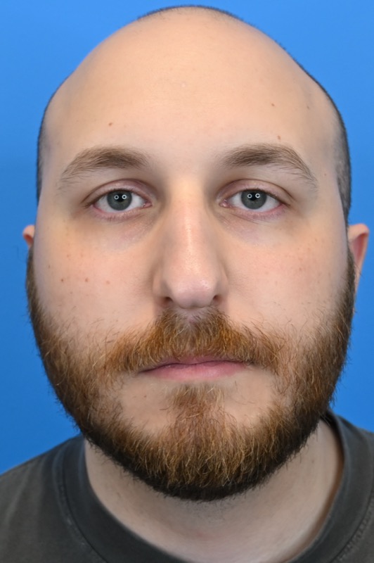Rhinoplasty Before & After Image