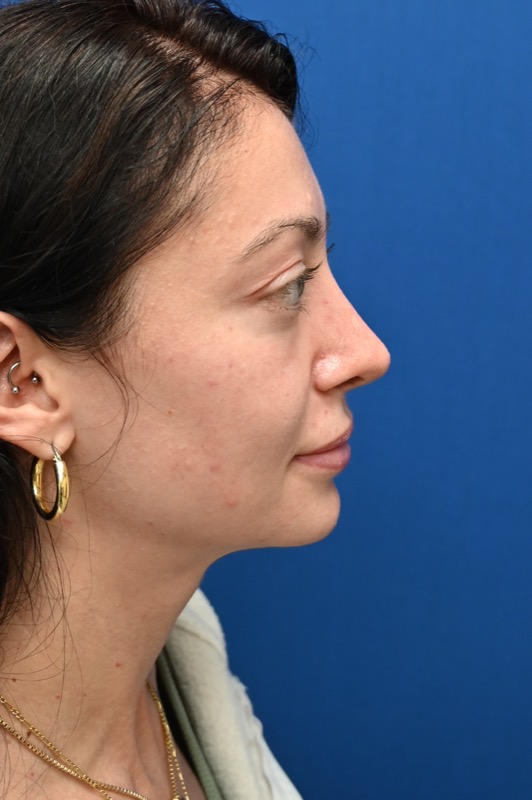 Rhinoplasty Before & After Image