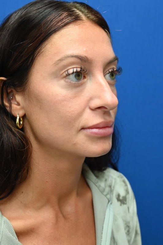 Rhinoplasty Before & After Image
