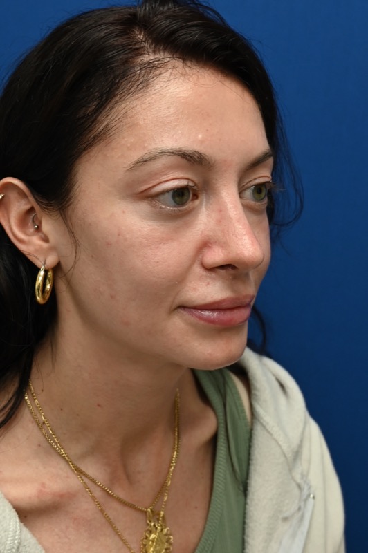 Rhinoplasty Before & After Image