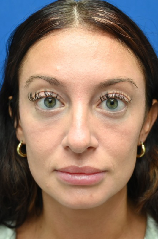 Rhinoplasty Before & After Image
