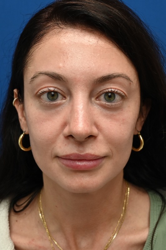 Rhinoplasty Before & After Image