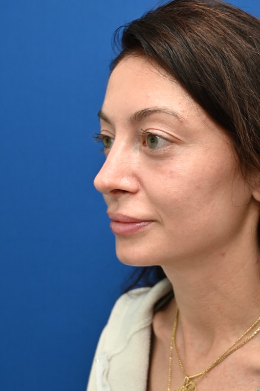 Rhinoplasty Before & After Image