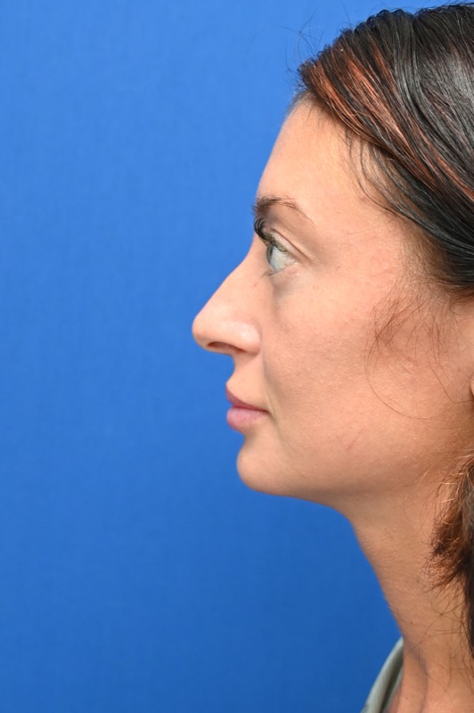 Rhinoplasty Before & After Image