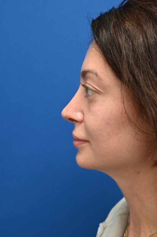 Rhinoplasty Before & After Image